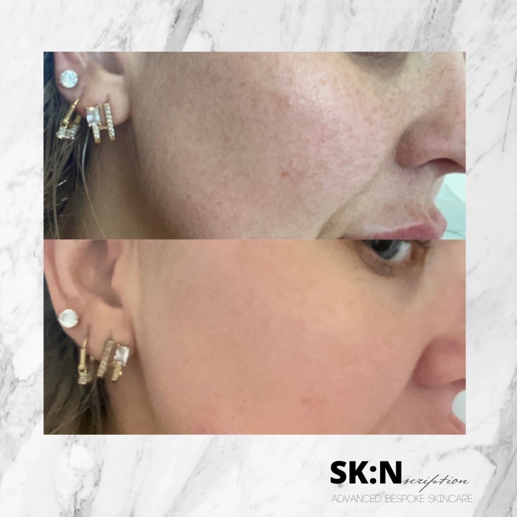 skincare rossendale before and after, chemical peel before and after, acne before and after, facial before and after, microneedling before and after
