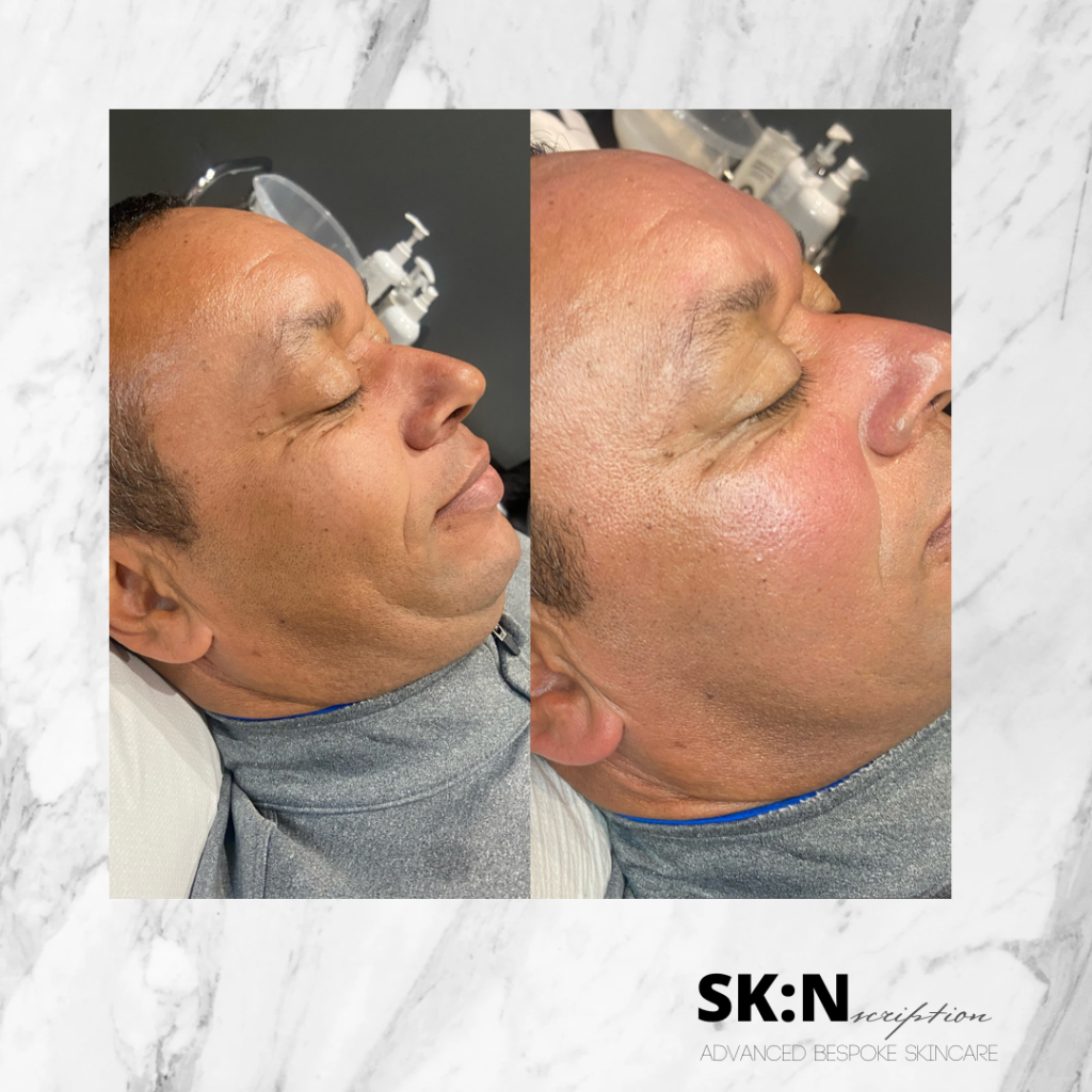 skincare rossendale before and after, facials for men, skincare rossendale before and after, chemical peel before and after, acne before and after, facial before and after, microneedling before and after