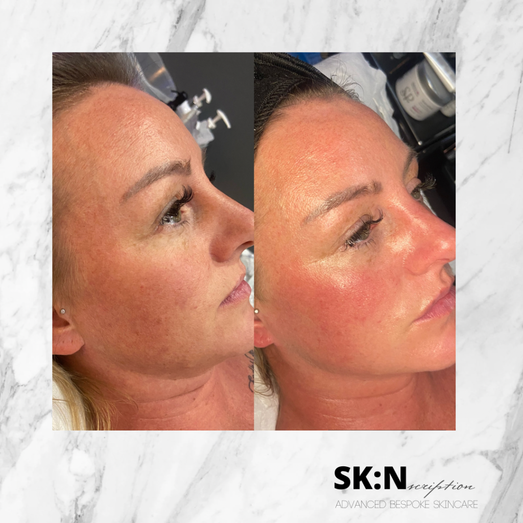 skincare rossendale before and after, chemical peel before and after, acne before and after, facial before and after, microneedling before and after